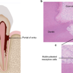 تحلیل سرویکال (External Cervical Resorption)؛ تشخیص، طبقه‌بندی و درمان از دیدگاه اندودانتیکس
