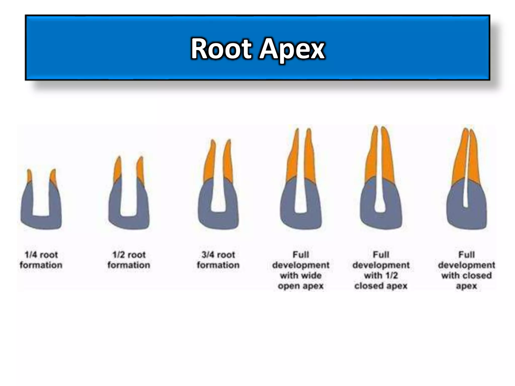 Open Apex در درمان ریشه به چه معناست؟ | بررسی علل، چالش‌ها و روش‌های درمان