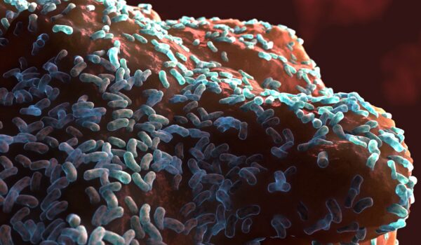 نقش Biofilm در شکست درمان ریشه؛ چرا باکتری‌ها از بین نمی‌روند؟