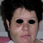 حادثه هیپوکلریت سدیم در درمان ریشه؛ پیشگیری، تشخیص و مدیریت Sodium Hypochlorite Accident
