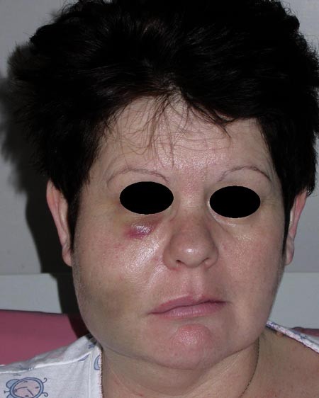 حادثه هیپوکلریت سدیم در درمان ریشه؛ پیشگیری، تشخیص و مدیریت Sodium Hypochlorite Accident