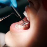 پرفوریشن ریشه چیست و چگونه درمان می‌شود؟ بررسی علل، علائم، تشخیص با CBCT و میکروسکوپ و درمان پرفوریشن ریشه با MTA و مواد بیوسرامیک.