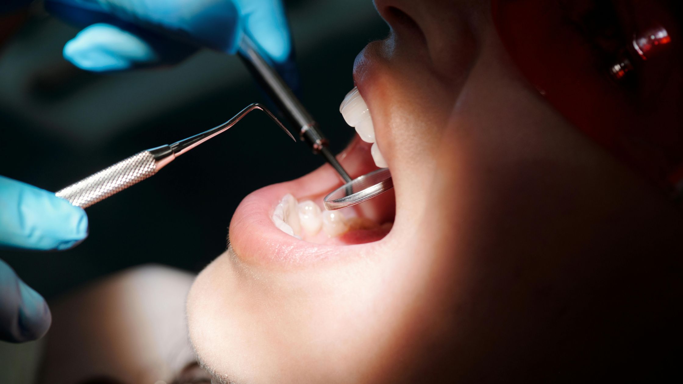 پرفوریشن ریشه چیست و چگونه درمان می‌شود؟ بررسی علل، علائم، تشخیص با CBCT و میکروسکوپ و درمان پرفوریشن ریشه با MTA و مواد بیوسرامیک.
